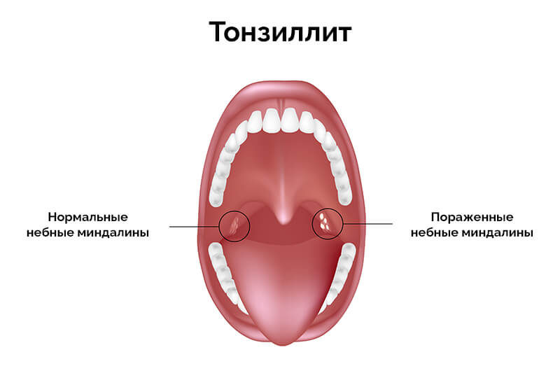 Небные миндалины: нормальные и при тонзиллите.